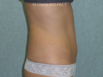 SmartLipo 607529