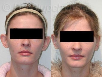 Otoplasty Plastic Surgery before 1117228