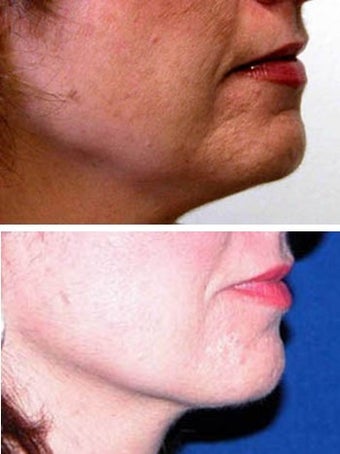 Thermage to jaw line and chin before 6570