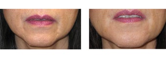 Juvederm/Fat Grafting before 718220