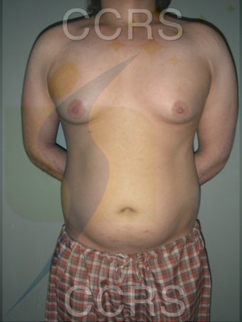 VASER Lipo - 28 yrs. old male (abdomen, back & chest) before 636089