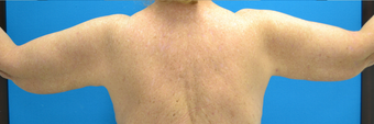 SmartLipo Before & After after 666628