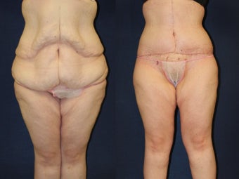 29 year old woman treated for excess skin following weight loss before 1251777