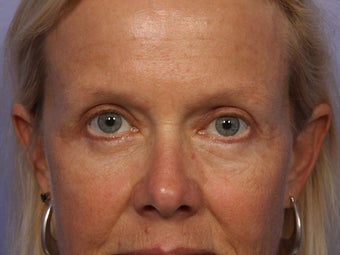 Eyelid Surgery after 280868