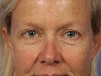 Eyelid Surgery before 280868