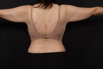 56 year old female, bra line back lift 938126