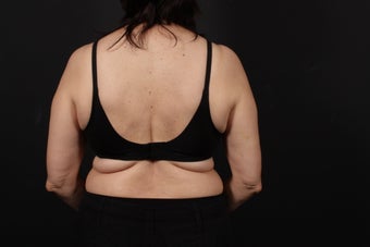 56 year old female, bra line back lift before 938126