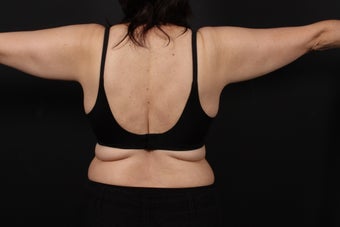 56 year old female, bra line back lift 938126