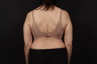56 year old female, bra line back lift after 938126