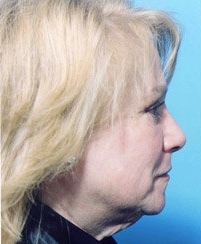 Facelift 507836