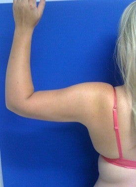 Laser Liposuction after 561205