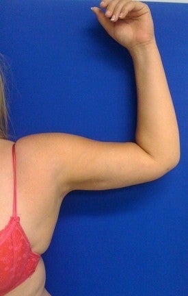 Laser Liposuction 561205