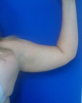 Laser Liposuction 561205