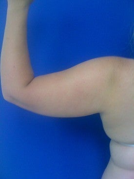 Laser Liposuction before 561205