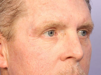 Eyelid Surgery after 280848