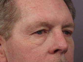 Eyelid Surgery before 280848