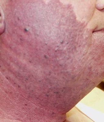 Vascular malformations or birthmarks before 135916
