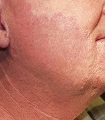 Vascular malformations or birthmarks after 135916