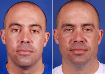 Mandibular angle augmentation before 1341242