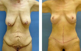 Body lift following massive weight loss before 84848