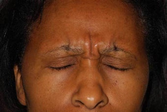 Female Treated with Botox before 1044785