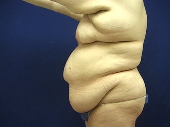 Lower body lift following massive weight loss before 715501