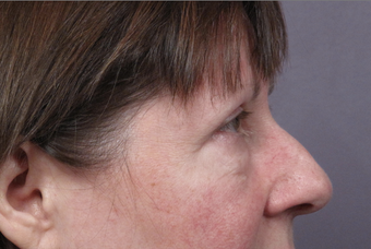 Eyelid Surgery 302504