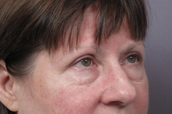 Eyelid Surgery before 302504