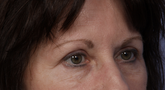Eyelid Surgery after 302504