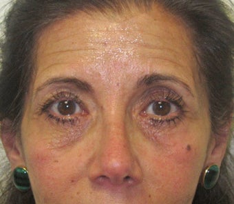 Facial wrinkles, lower lid rhytids (wrinkles) and tear trough hollows. Note the mild right brow ptosis prior to botox. before 1034848