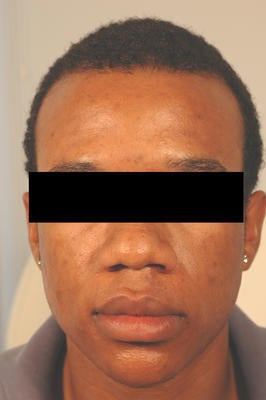 Laser Acne Scar Removal after 82959