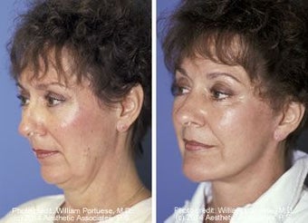 Chin Implant before 91337