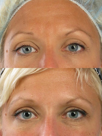 Botox for frown lines and crow's feet before 56683