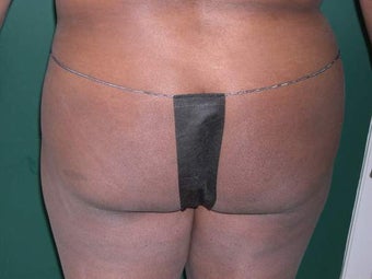 Buttock Augmentation before 330215