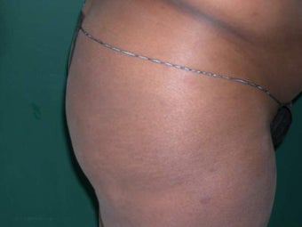 Buttock Augmentation 330215