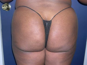 Buttock Augmentation after 330215