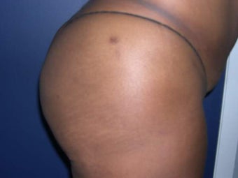 Buttock Augmentation 330215