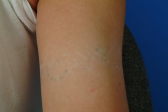QSR Ruby Laser Tattoo Removal after 329682
