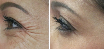 Botox for treatment of crows feet before 987773