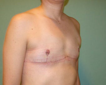 FTM "Top Surgery" 867213