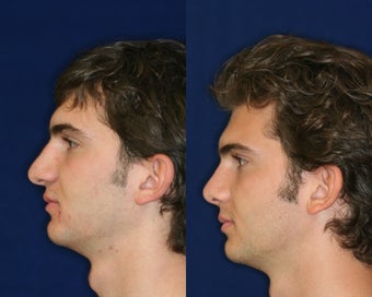 Rhinoplasty before 229779