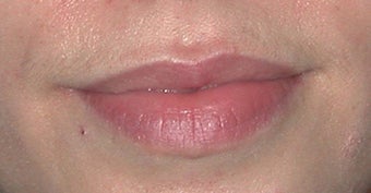 Lip Augmentation before 91091