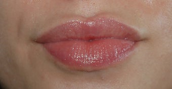 Lip Augmentation after 91091