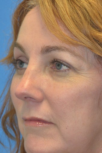 Browlift w hairline lowering, Upper eye blepharoplasty, Lower eyelid skin pinch, Fat transfer 806961