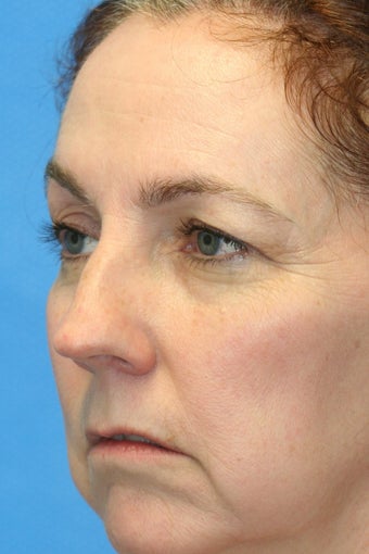Browlift w hairline lowering, Upper eye blepharoplasty, Lower eyelid skin pinch, Fat transfer 806961