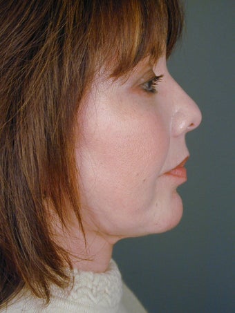 Female Chin Implant after 831856
