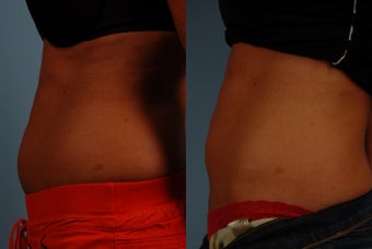 Trusculpt before 758710