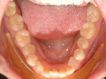 Invisalign treatment for crowded teeth with a cross-bite 881776