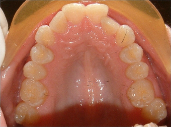Invisalign treatment for crowded teeth with a cross-bite before 881776