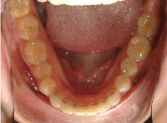 Invisalign treatment for crowded teeth with a cross-bite 881776